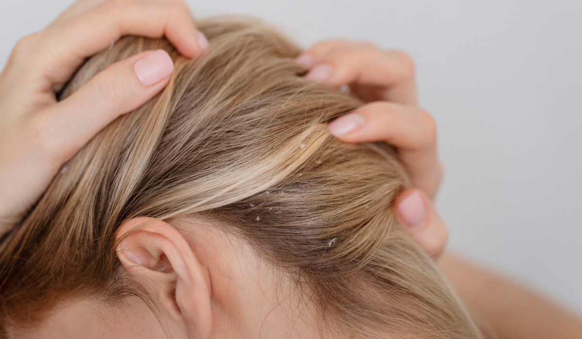 Caspa, ¿cómo prevenirla y tratarla?